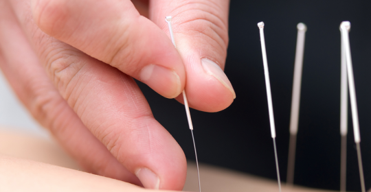 Acupuncture and Stress